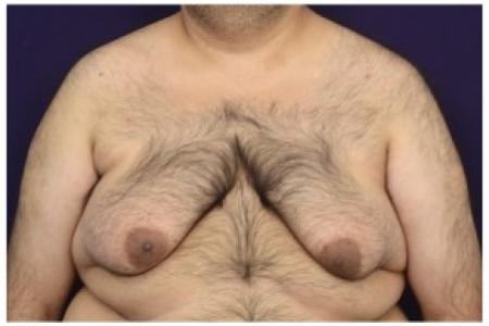 Before image 1 Case #86921 - Gynecomastia