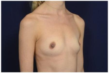 Before image 2 Case #86926 - Breast Augmentation