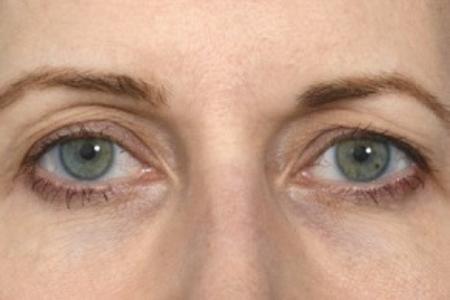 Before image 1 Case #87621 - Eye Area Rejuvenation
