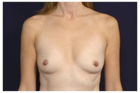 Before image 1 Case #87071 - Breast Augmentation