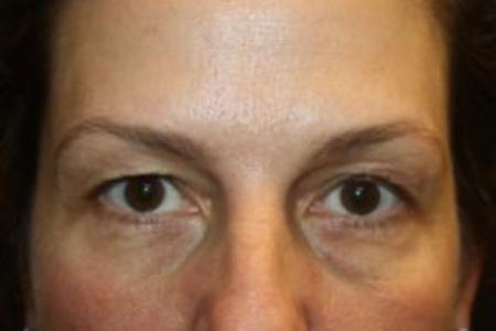 Before image 1 Case #85871 - Blepharoplasty and Browlift - 49 year old female