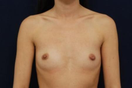 Before image 1 Case #87746 - Breast Augmentation