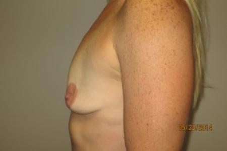 Before image 3 Case #82416 - 40 Female Breast Lift