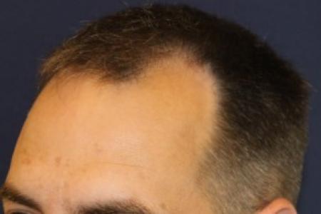 Before image 3 Case #87376 - Hair Transplantation San Diego