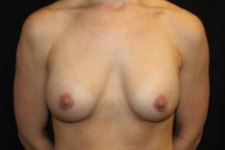 Before image 1 Case #84871 - Breast Implant Exchange - 37 year old female