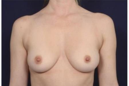 Before image 1 Case #86866 - Breast Augmentation
