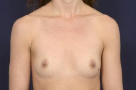 Before image 1 Case #87511 - Breast Augmentation