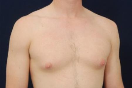 Before image 2 Case #87741 - Gynecomastia