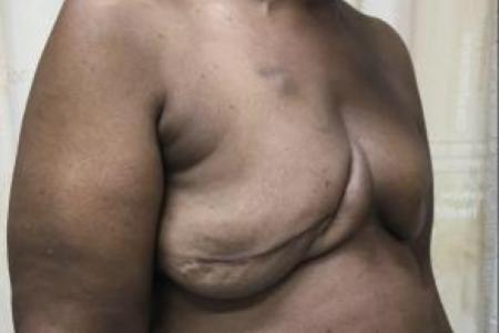 Before image 2 Case #88176 - Breast Reconstruction on a 63 year old patient