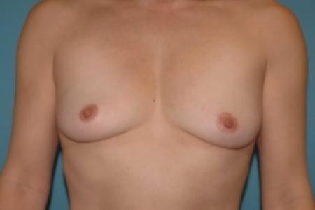 Before image 1 Case #86156 - Breast Augmentation with Silicone Implants