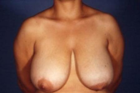 Before image 1 Case #81451 - Breast Reduction/Lift
