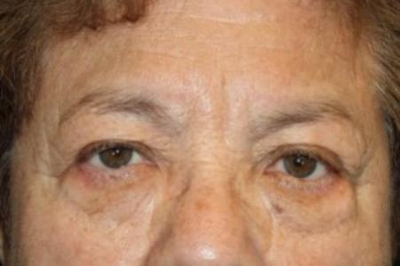 Before image 1 Case #84706 - Blepharoplasty and Brow Lift - 78 year old female.