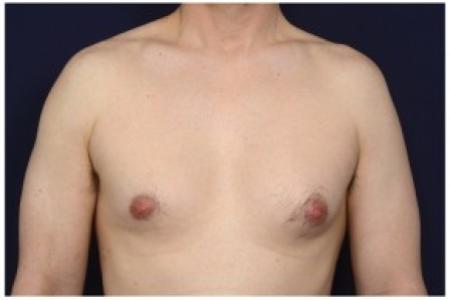 Before image 1 Case #86206 - 42 year old man treated with Male Breast Reduction
