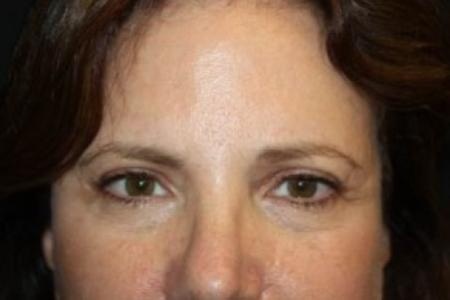 Before image 1 Case #84271 - Brow Lift- 60 year old female