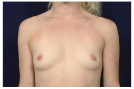 Before image 1 Case #87486 - Breast Augmentation