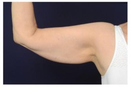 Before image 1 Case #86996 - Upper Arm Lift