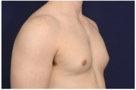 Before image 2 Case #86211 - 32 year old man treated with Male Breast Reduction