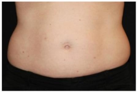 Before Case #86356 - 40 yr old treated with nonsurgical fat reduction.