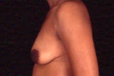 Before image 3 Case #81471 - Breast Augmentation/Lift