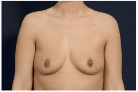 Before image 1 Case #84786 - Breast Augmentation