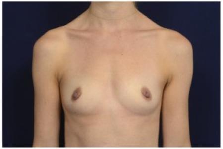 Before image 1 Case #86926 - Breast Augmentation