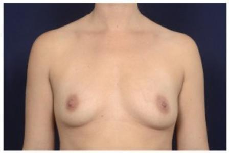 Before image 1 Case #87536 - Breast Augmentation