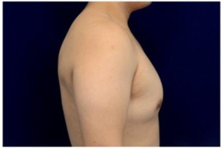 Before image 3 Case #82176 - Gynecomastia