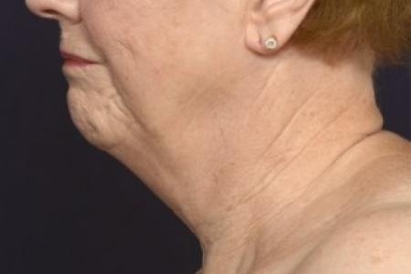 Before image 3 Case #87136 - Lower Facial Rejuvenation