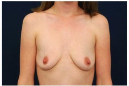 Before image 1 Case #82021 - Breast Augmentation