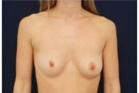 Before image 1 Case #81996 - Breast Augmentation