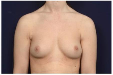 Before image 1 Case #86226 - 24 year old woman treated with Breast Augmentation