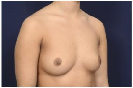 Before image 2 Case #86241 - 28 year old woman treated with Breast Augmentation