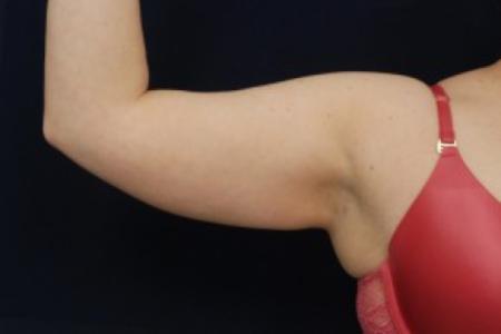 Before image 2 Case #87721 - Upper Arm Liposuction
