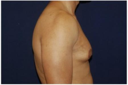 Before image 3 Case #82076 - Gynecomastia