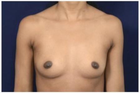 Before image 1 Case #86876 - Breast Augmentation