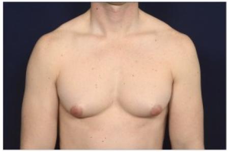 Before image 1 Case #85596 - Gynecomastia