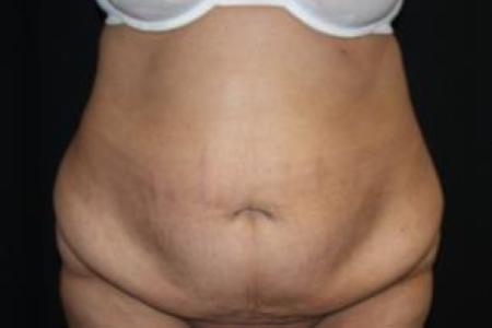 Before image 1 Case #85866 - Total Body Lift - 57 year old female