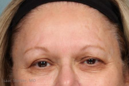 Before image 1 Case #88181 - Upper and Lower Eyelid Lift with Lateral Brow Lift