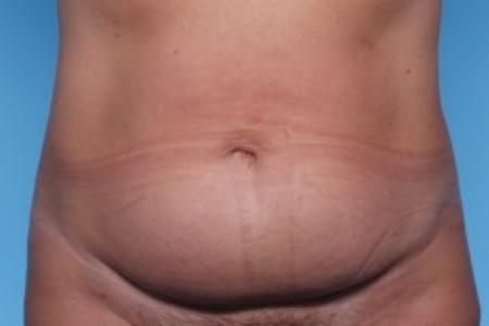 Before image 1 Case #82231 - Liposuction