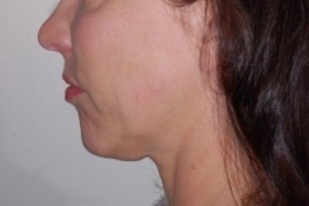 Before image 2 Case #87216 - Chin Implant