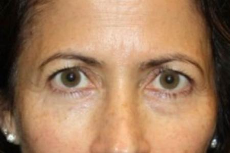 Before image 1 Case #84886 - Upper LidBlepharoplasty & Brow Lift - 50 year old female