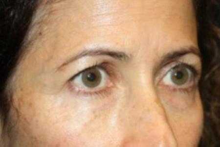 Before image 2 Case #84886 - Upper LidBlepharoplasty & Brow Lift - 50 year old female