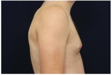 Before image 3 Case #86916 - Gynecomastia