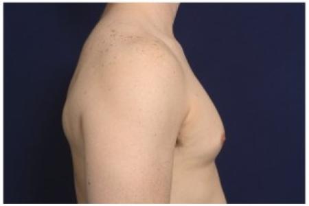 Before image 3 Case #86211 - 32 year old man treated with Male Breast Reduction