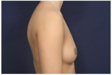 Before image 3 Case #86241 - 28 year old woman treated with Breast Augmentation