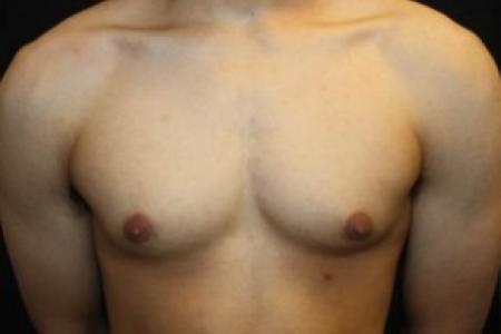 Before image 1 Case #85276 - Gynecomastia - 17 year old male 