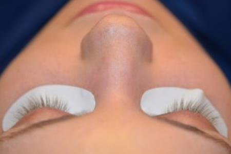 Before image 1 Case #86371 - 25 year old woman treated with eyelash enhancement.
