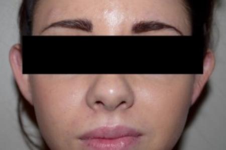 Before image 1 Case #83046 - Otoplasty