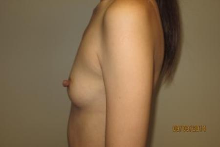 Before image 3 Case #82431 - 25 Female Breast Augmentation