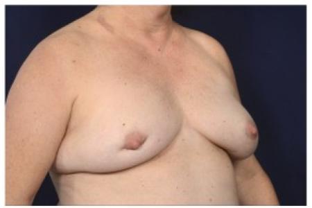 Before image 2 Case #87606 - Breast Augmentation Revision